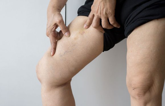 Come affrontare e prevenire le vene varicose